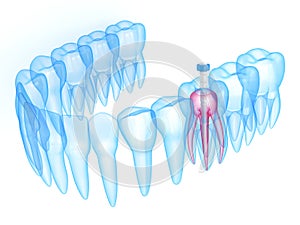 3d render of jaw with teeth and fiber post over white