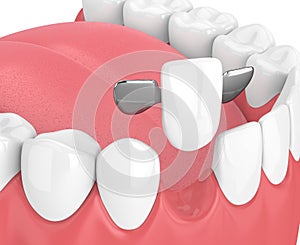 3d render of jaw with teeth and maryland bridge
