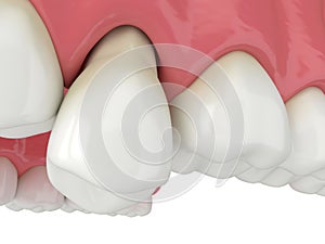 3d render of jaw with tooth protruding from the gums