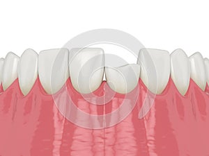 3d render of lower jaw with broken incisor tooth