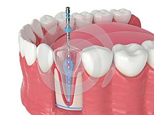 3d render of lower jaw with endodontic rotary file over white background