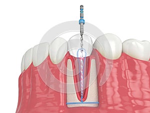 3d render of lower jaw with endodontic rotary file over white background