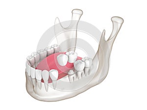 3d render of  mandible with dental cantilever bridge over white