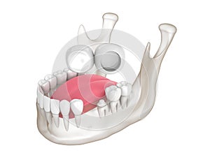 3d render of  mandible with dental cantilever bridge over white