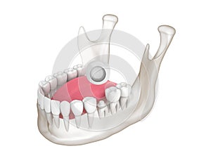 3d render of mandible with dental crown embed on reshaped tooth over white