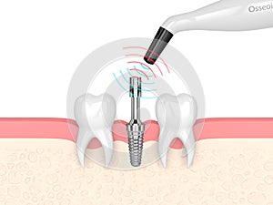 3d render of osseointegration monitoring device checking dental implant stability