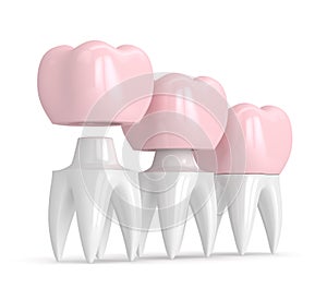 3d render of replacement crown cemented onto reshaped tooth