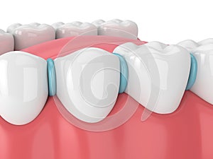 3d render of rubber separator between teeth