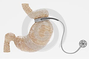 3D Render of Stomach with Gastric Band