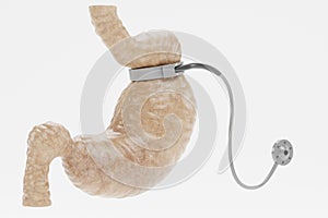 3D Render of Stomach with Gastric Band