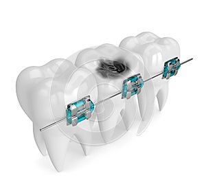 3d render of teeth with braces and caries