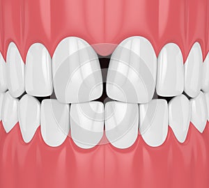 3d render of teeth with convergent diastema