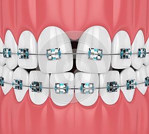 3d render of teeth with convergent diastema and braces