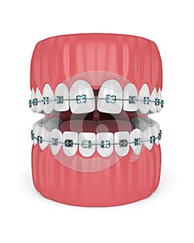 3d render of teeth with convergent diastema and braces