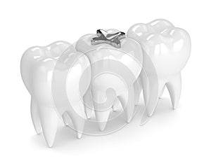 3d render of teeth with dental amalgam filling