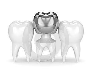 3d render of teeth with dental crown amalgam filling