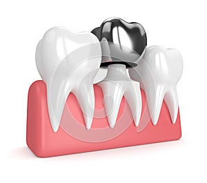 3d render of teeth with dental crown amalgam filling