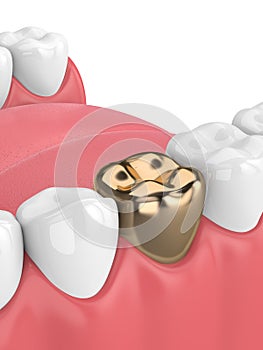 3d render of teeth with dental golden crown