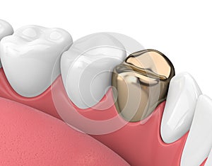 3d render of teeth with dental golden crown