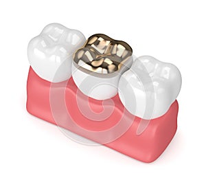 3d render of teeth with dental golden onlay filling