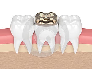 3d render of teeth with dental golden onlay filling