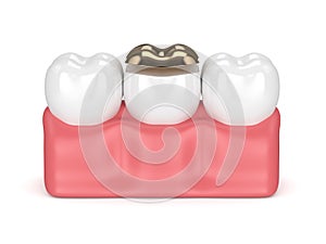 3d render of teeth with dental golden onlay filling