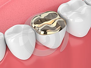 3d render of teeth with dental golden onlay filling