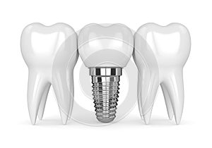 3d render of teeth with dental implant