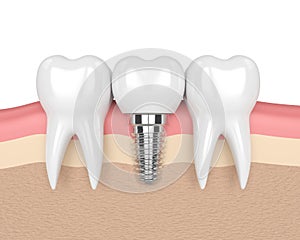 3d render of teeth with dental implant in gums