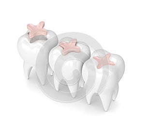 3d render of teeth with dental inlay filling