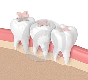 3d render of teeth with dental inlay filling