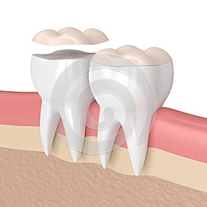 3d render of teeth with dental onlay