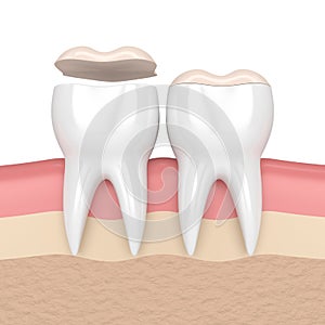 3d render of teeth with dental onlay