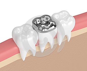 3d render of teeth with dental onlay amalgam filling