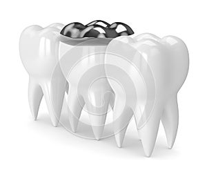 3d render of teeth with dental onlay amalgam filling