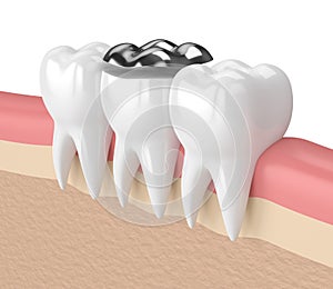 3d render of teeth with dental onlay amalgam filling