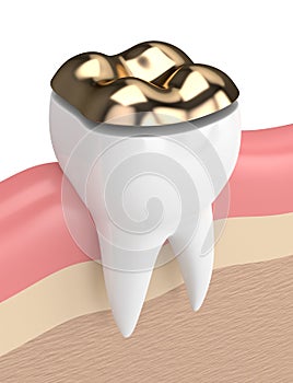 3d render of teeth with dental onlay filling