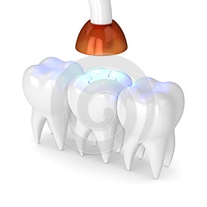 3d render of teeth with dental polymerization lamp and light cured inlay