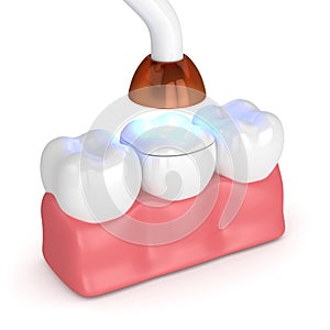 3d render of teeth with dental polymerization lamp and light cured onlay