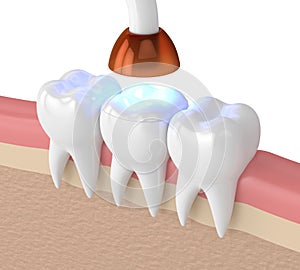 3d render of teeth with dental polymerization lamp and light cured onlay