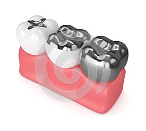 3d render of teeth with different types of dental amalgam filling