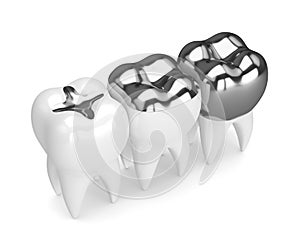 3d render of teeth with different types of dental amalgam filling