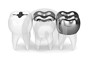 3d render of teeth with different types of dental amalgam filling