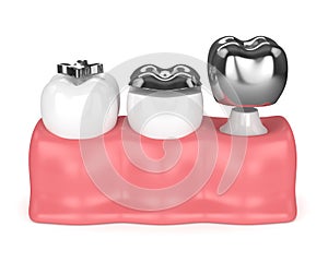 3d render of teeth with different types of dental amalgam filling