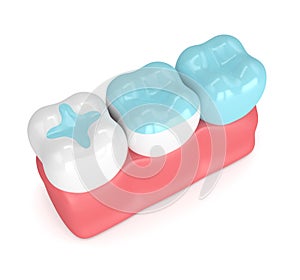 3d render of teeth with different types of filling