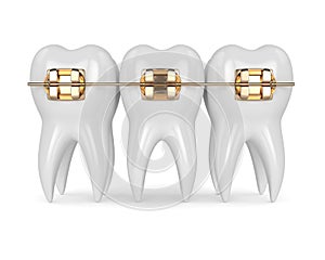 3d render of teeth with golden orthodontic braces