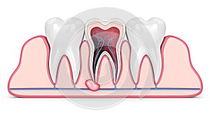 3d render of teeth in gums with cyst