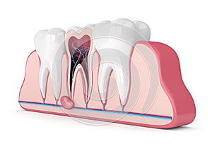 3d render of teeth in gums with cyst