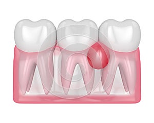 3d render of teeth in gums with cyst