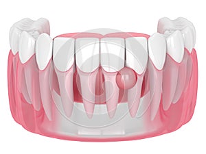 3d render of teeth in gums with cyst